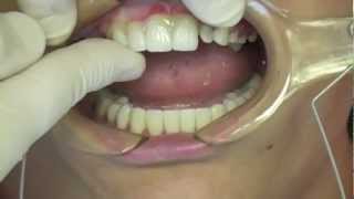 Resin Cementation of eMax Porcelain Veneers and Crowns [upl. by Melville241]