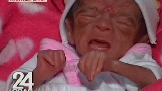 24 Oras Premature baby na ubod nang liit normal na ang kalagayan matapos ang 2 buwang gamutan [upl. by Errot611]