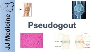 Pseudogout  Pathophysiology Symptoms and Treatment [upl. by Ursal]