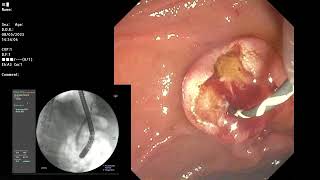 ERCP  Simple cannulation technique for ERCP by upscope maneuver after tip of catheter engaged [upl. by Kurys]