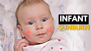 How To Prevent and Treat Infant Sunburn [upl. by Sokram783]