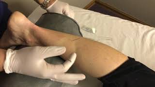 Dry Needling For Heel Pain In a Running Athlete  Columbus Ohio  Dr Daniel Leonard [upl. by Loomis]