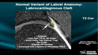 MRI Online Hip Pathology Part I Normal Variants and Pitfalls [upl. by Anrehs460]