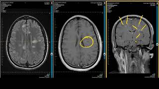 ADC Positive Multiple Sclerosis  Demyelination MRI Case Review [upl. by Buck370]