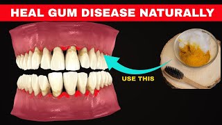 Periodontitis Treatment How to cure periodontitis gum disease at home  Easy Remedies [upl. by Lanny]