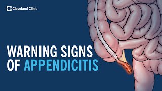 Warning Signs of Appendicitis [upl. by Ahsenar768]