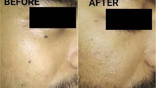 Mole Removal  Aura Skin and Hair Clinic  Dr Nidheesh Agarwal [upl. by Butcher]