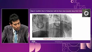 Learn the evidence  Lifetime management of aortic stenosis therapy with selfexpandable valve [upl. by Specht]