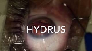 Hydrus for Glaucoma [upl. by Mccollum392]