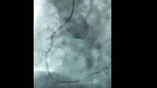 Ostial RCA stenting  90 seconds guide [upl. by Llevart]