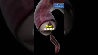 Common Issues Associated With Heart Valve Conditions Explained  SIMS Hospital Chennai [upl. by Meluhs]