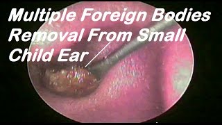 Multiple Foreign Bodies Removal From Small Child Ear [upl. by Kcired553]