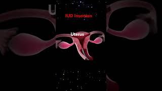 How an IUD is inserted ytshort contraception iud September 8 2024 [upl. by Rolandson]