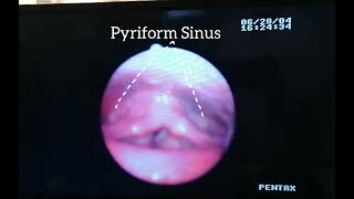 Nasopharyngolaryngoscopy NPL showing Vocal cord polyp and Reinke’s edema [upl. by Aleira]