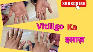 Vitiligo ka treatment Ke liye Gaya harshvlogs vlogs vitiligotreatment [upl. by Kcirdef]