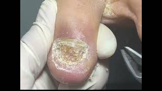 Fungal nail treatment watch till end to see what treatment I used [upl. by Arabella]