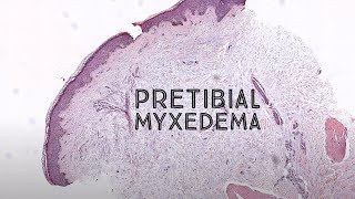 Pretibial myxedema Graves disease thyroid dermopathy pathology dermpath dermatology USMLE [upl. by Orr785]