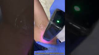 Hair removal Treatment [upl. by Annuahs]