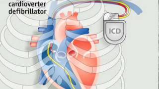 How pacemakers work [upl. by Chitkara414]