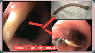 Throat Foreign Body Removal Of  গলায় আটকে যাওয়া মুরগির হাড় বের করা হলো BDENDOSCOPY [upl. by Oran]