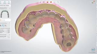 Módulo  guía para gingivectomía [upl. by Skell]