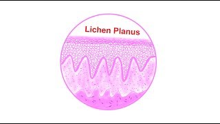 Lichen planus Histopathological features  Lets draw [upl. by Llertnor873]