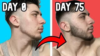 Minoxidil Beard Growth Week 11 [upl. by Nnagrom]