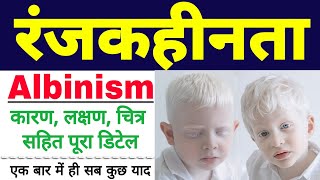 रंजकहीनता  Albinism disease in hindi  albinism class 12 biology  symptoms  biology ScienceSK [upl. by Lawton77]