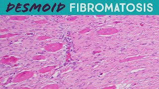 Desmoid Tumor Fibromatosis explained in 5 minutes pathology usmle FAP familial adenomatosis coli [upl. by Imak]