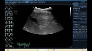 IQ 155 LIVER HEPATOMA ULTRASOUND ECHOPAC ECHOCARDIOGRAPHY HEPATOMA C1 5 RS PROBE [upl. by Spring248]