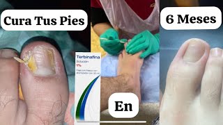 Como Cure Los Hongos De Mis Pies En 6 Meses [upl. by Zenia]