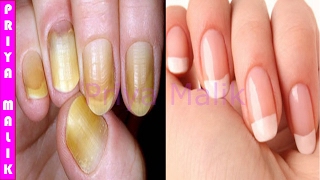 नाखूनों को सफ़ेद करने के लिए सबसे अच्छा तरीका Only in 10 minutes  How to Whiten your Yellow Nails [upl. by Suilmann]