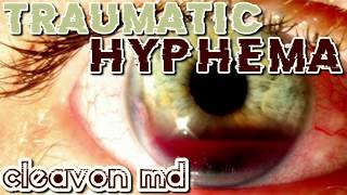 Cleavon MD  Traumatic Hyphema [upl. by Sylera]