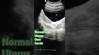 Normal pelvic scan ultrasound doctor usg uterus ovary cervix [upl. by Rovelli]