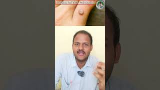 Wart remover in tamil  wart remover  wart  wart remover ointment review in tamil  Dr balajimuthu [upl. by Aimal573]