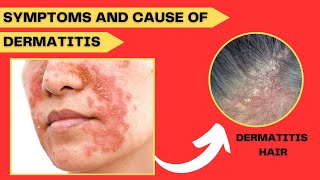 Symptoms and Cause of Dermatitis Disease  Causes  Sign  Your Doctor [upl. by Hakceber]