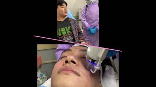 Synergistic Acne Scar Treatment with Mr Jun Sisa Interview and Procedure [upl. by Ahsuoj]