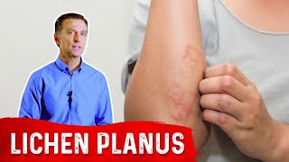 Lichen Planus Best Remedy [upl. by Figone416]