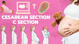 Csection animation  Cesarean section  Baby delivery animation [upl. by Corrina]