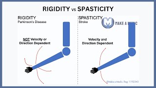 Rigidity vs Spasticity Explained [upl. by Zimmerman201]