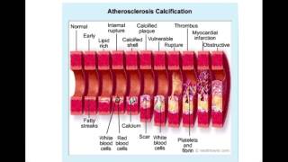 CTCAG Part 4 positive coronary artery remodeling [upl. by Danella]