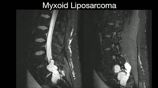 Myxoid Liposarcoma [upl. by Donal50]