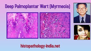 Pathology of Deep Palmoplantar Wart Myrmecia  Dr Sampurna Roy MD  dermpath dermatopathology [upl. by Arok135]