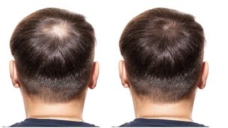 6 Foods That Can Block DHT and Fight Hair Loss [upl. by Fisk]