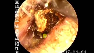 Earwax Removal Extractions Huge Size Earwax 一侧耳朵巨大耳屎 外耳道挖耳屎清理 耳垢 耳垢 [upl. by Brainard]