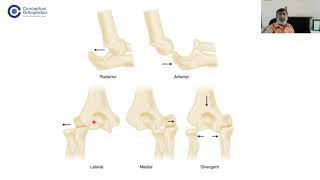 Elbow Instability ConceptualOrthopedics by FRCS Gold Medalists DrRavinder Dimri [upl. by Akemahs957]