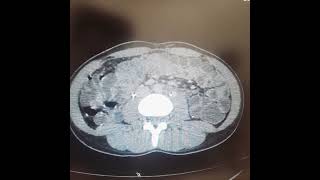 Ct Enterography with IV contrast [upl. by Skurnik]