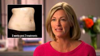 SculpSure Results Testimonials Before amp After Photos [upl. by Sapphire143]