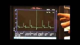 Secondary Ignition Waveforms common faults [upl. by Eciruam]