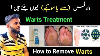 Warts Removal  How To Get Rid Of Warts masse At Home  Warts Treatment in Urdu  Types of Warts [upl. by Analli530]